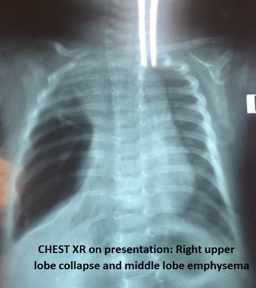 Emergency Lobectomy for Congenital Lobar Emphysema